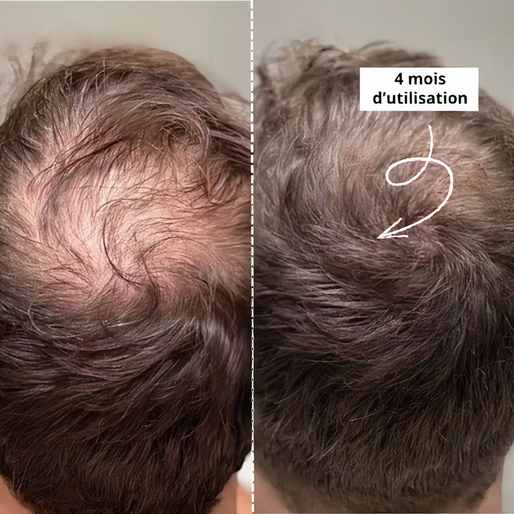 Dermaroller Cheveux 1200 Aiguilles 0,5mm | Qualité Pro