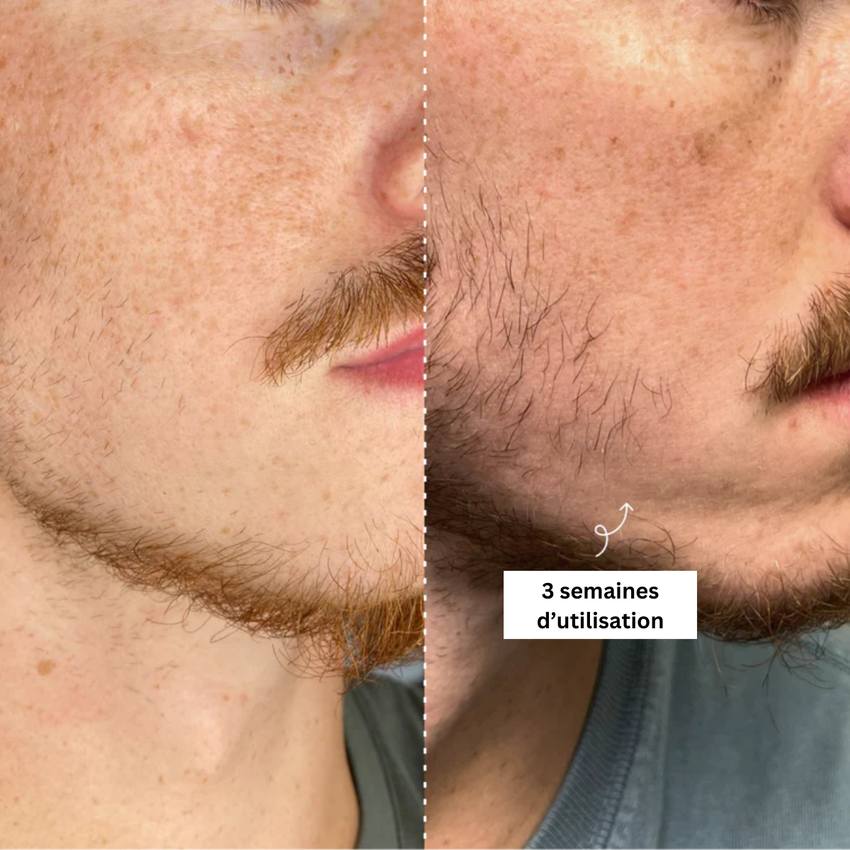 Beard-Roller | Dermaroller Spécial Barbe