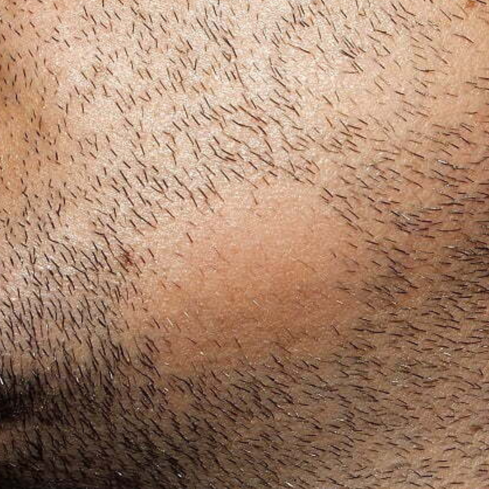 Pelade Barbe : Causes, Traitements et Solutions pour la Repousse