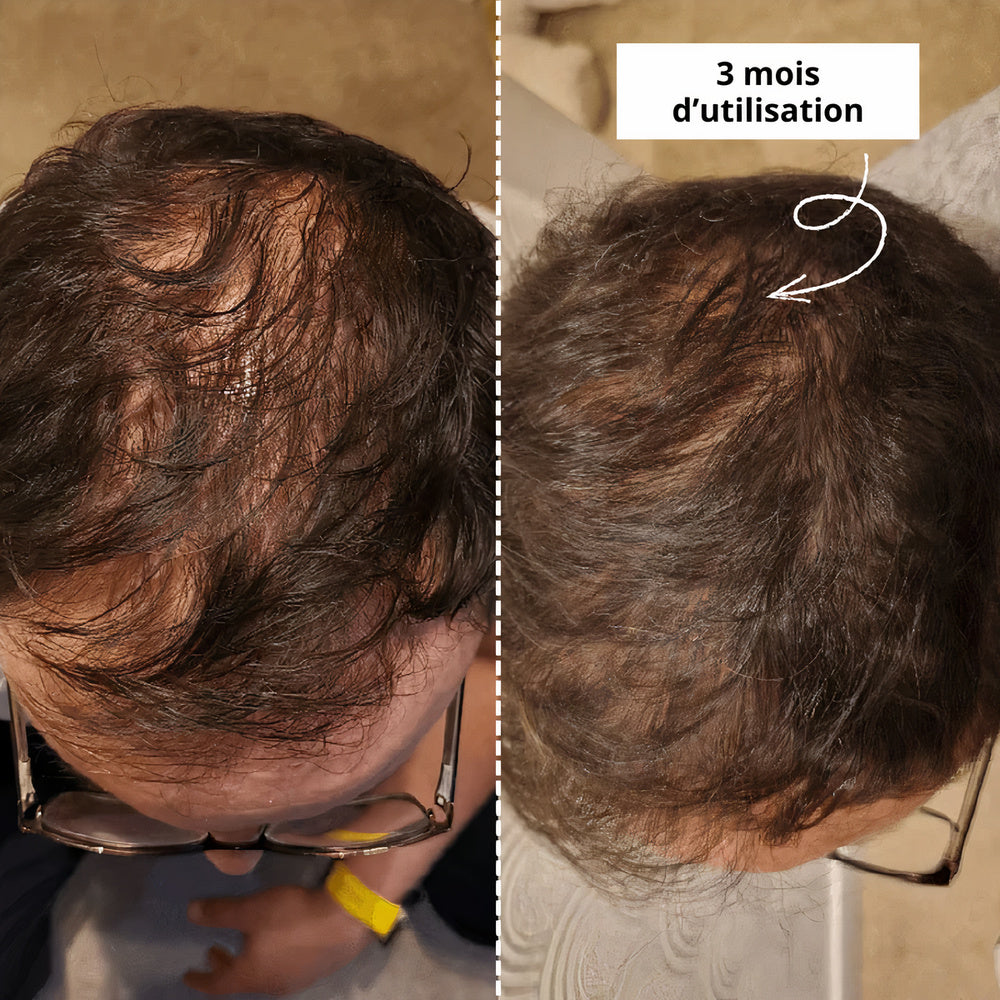 Sérum au Redensyl Activateur de Pousse Cheveux