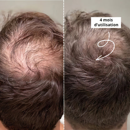 Dermaroller Cheveux 1200 Aiguilles 0,5mm | Qualité Pro