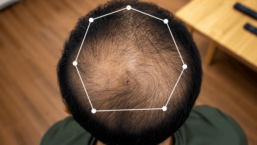Pourquoi tes cheveux tombent et perdent en densité ?