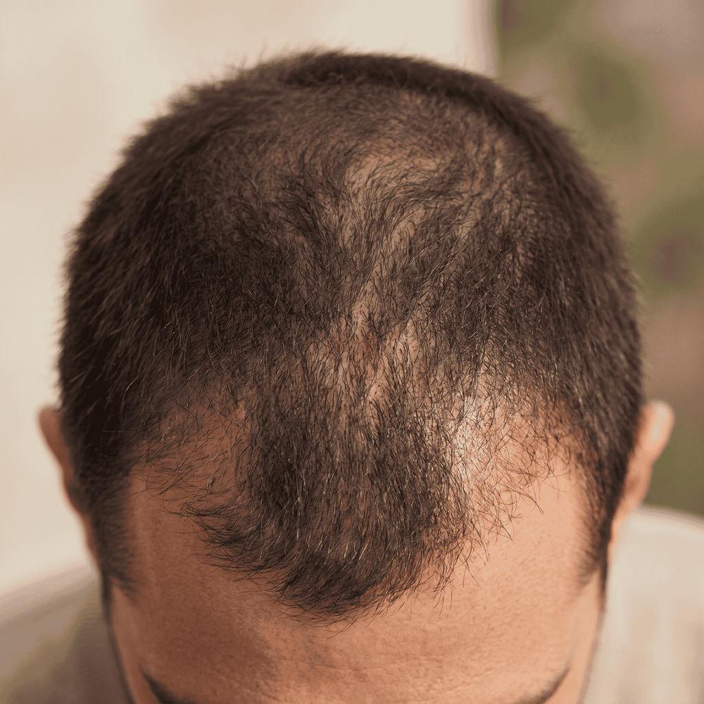 Pourquoi tes cheveux tombent ?